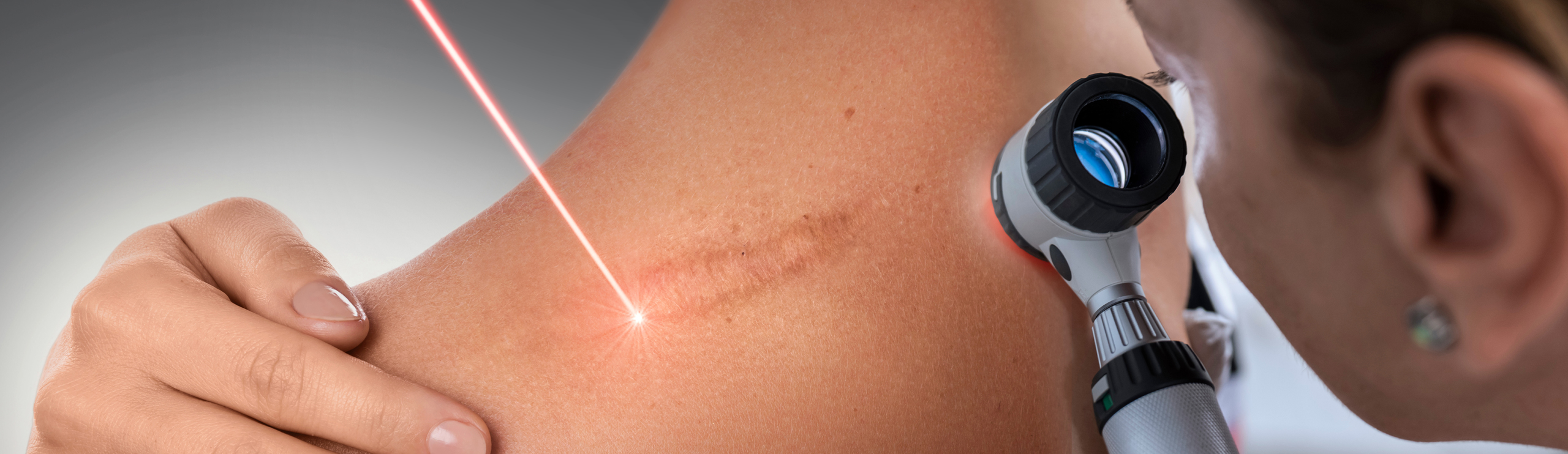Dermatologin untersucht mit einem Dermatoskop die Haut auf der Schulter einer Person, Laserstrahl zielt auf die Narbe